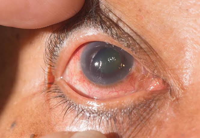 Cataras, retinopatia diabética y glaucoma principales enfermedades en guerrerenses